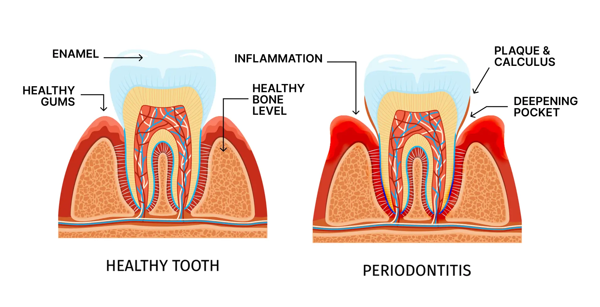 Hereditary Gum Disease