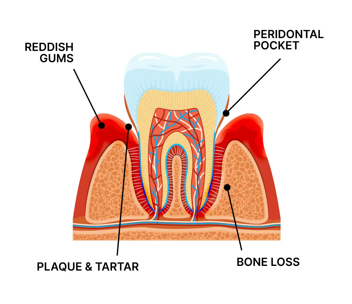Periodontitis symptoms