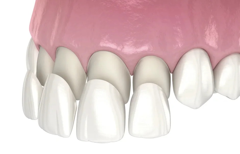 3D image showing laminate veneers treatment