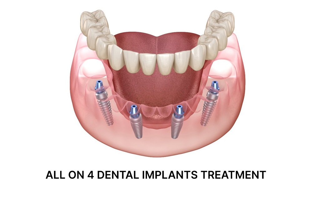 All on 4 dental implants