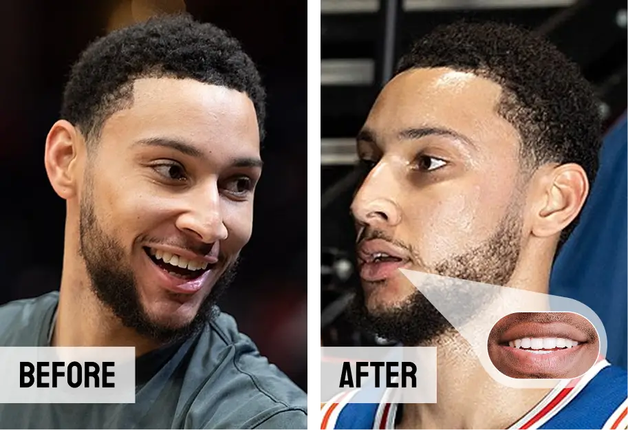 Ben Simmons Teeth Hollywood Smile