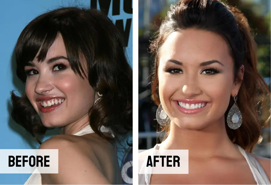 Demi Lovato Teeth Veneers