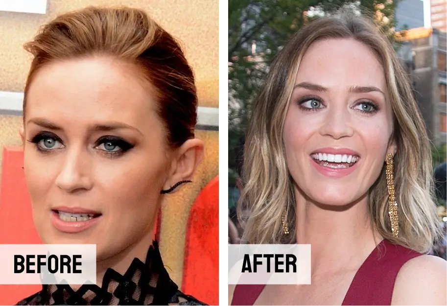 Emily Blunt Teeth Veneers