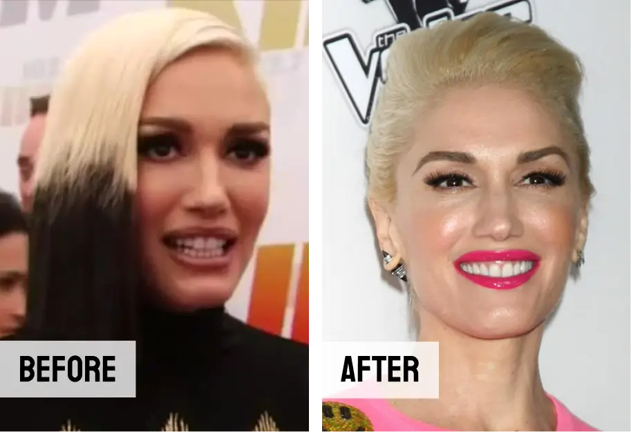 Gwen Stefani Teeth Veneers