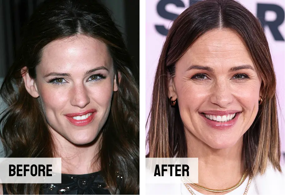 Jennifer Garner Teeth Transformation