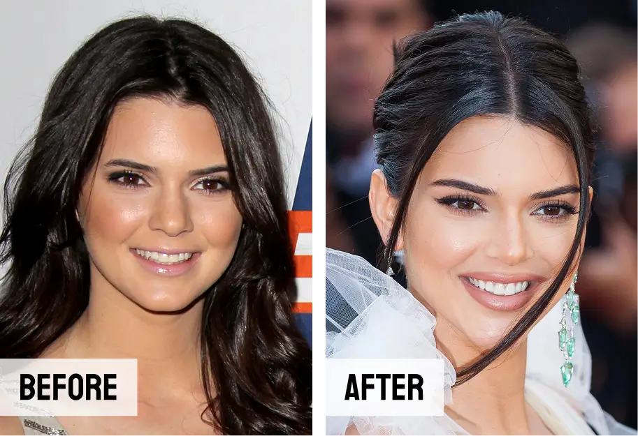 Kendall Jenner Teeth Veneers