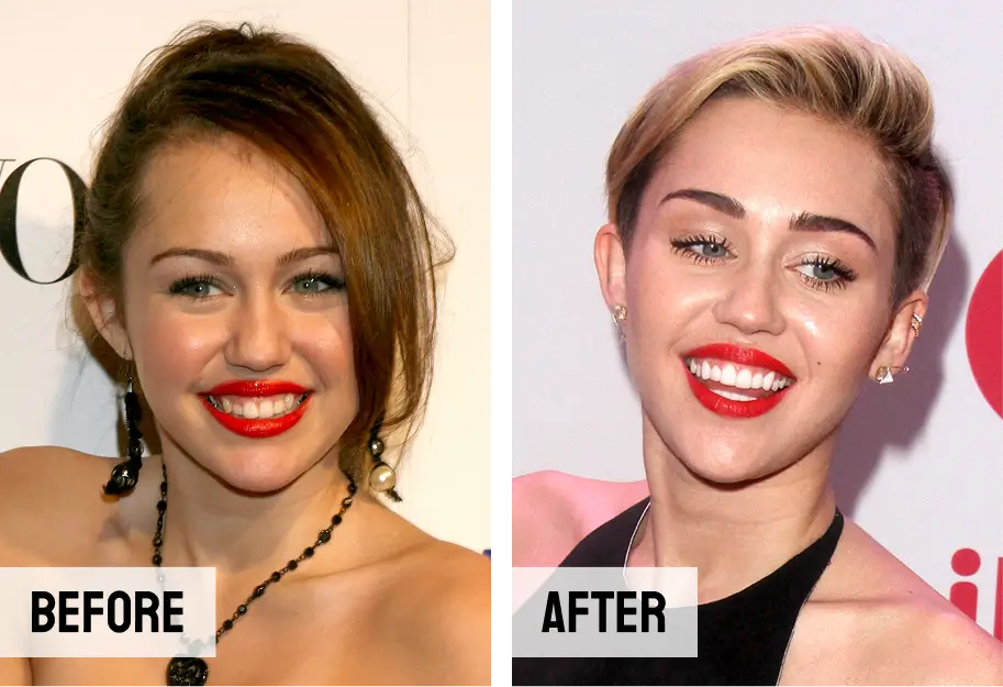 Miley Cyrus Teeth Porcelain Veneers