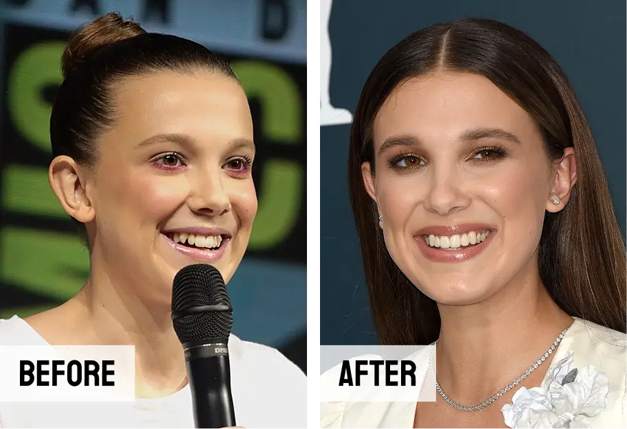 Millie Bobby Brown Teeth Invisalign