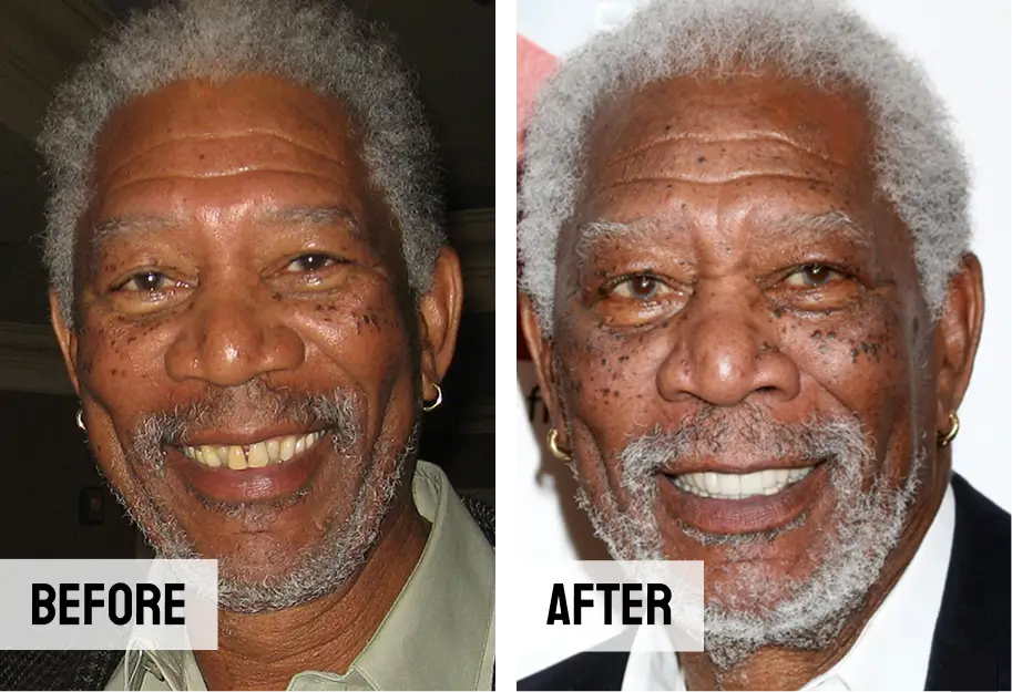 Morgan Freeman Teeth Dental Implant