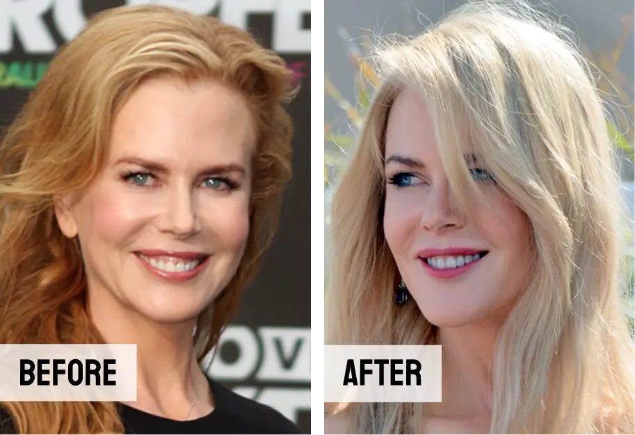 Nicole Kidman Teeth Gum Contouring