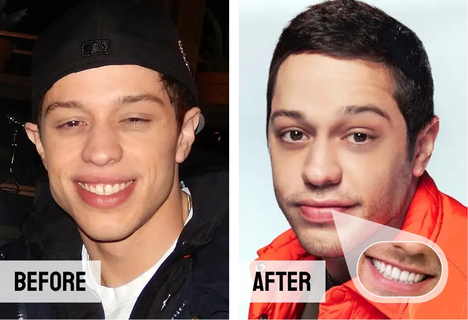 Pete Davidson Teeth Veneers
