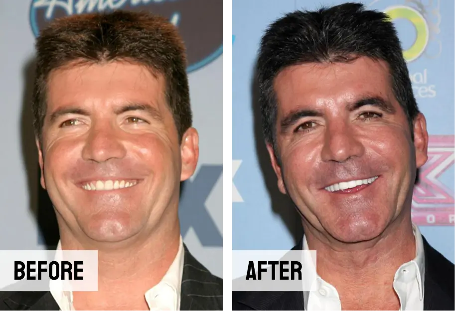 Simon Cowell Teeth E-max Veneers