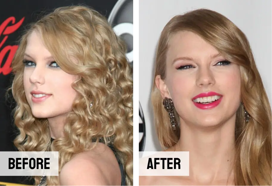 Taylor Swift Teeth Veneers Implants
