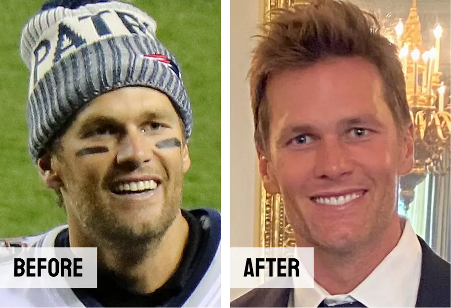 Tom Brady Teeth Veneers