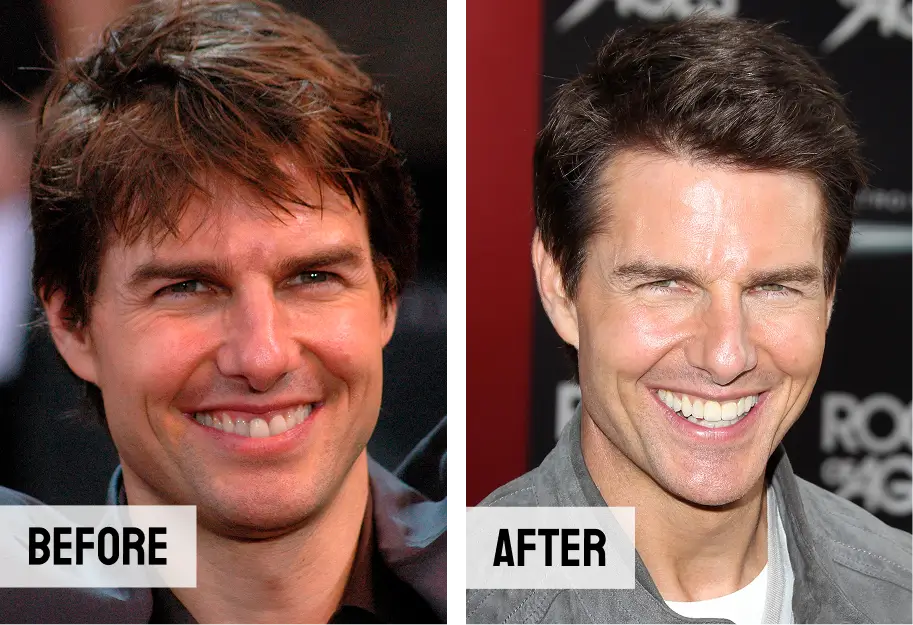Tom Cruise Teeth Veneers