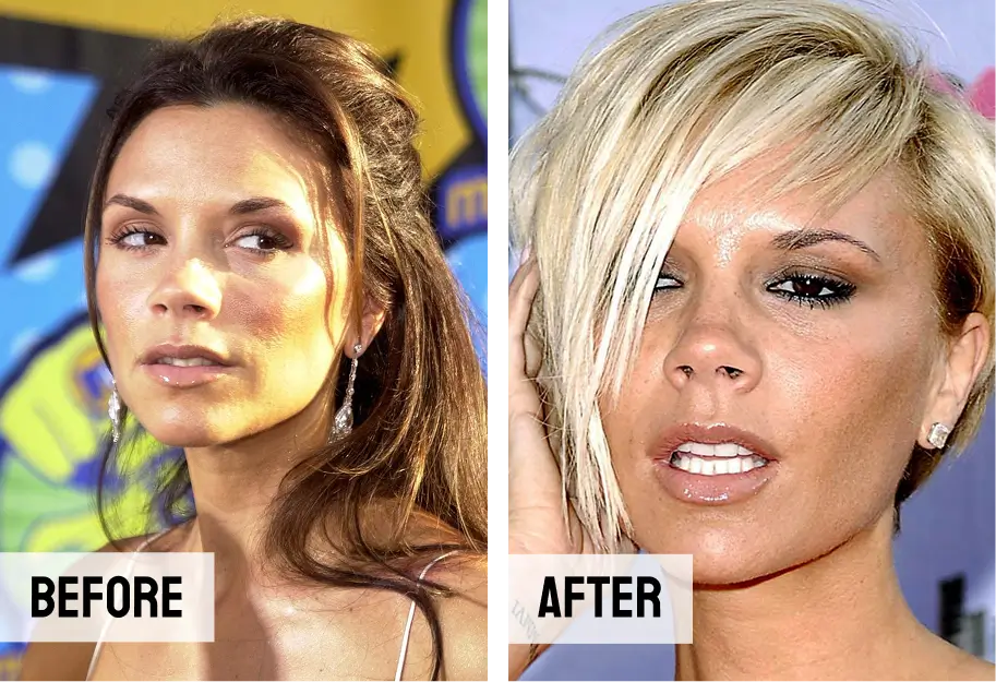 Victoria Beckham Teeth Veneers