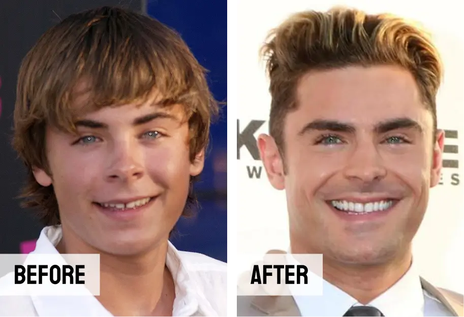 Zac Efron Teeth Veneers