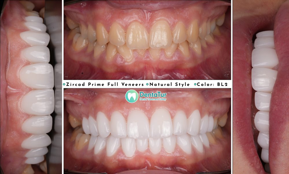 ZirCad Prime Full Veneers
