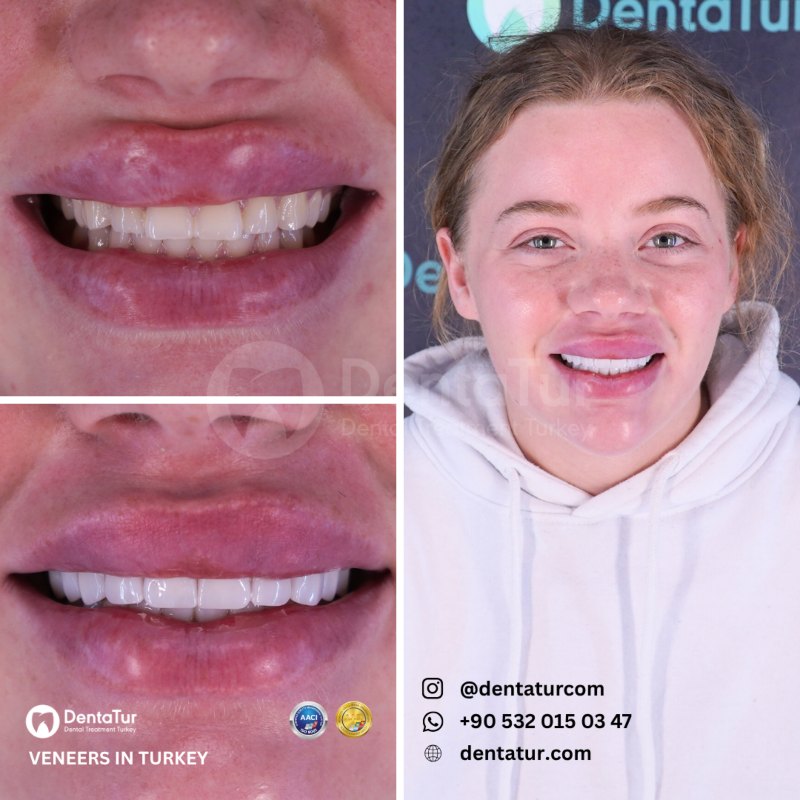 emax veneers in turkey