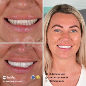 Laminate veneers in Turkey cost