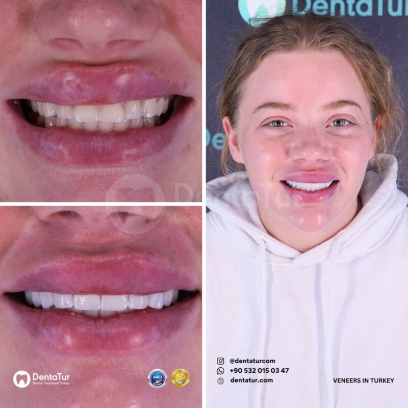 Composite Fillings Before After