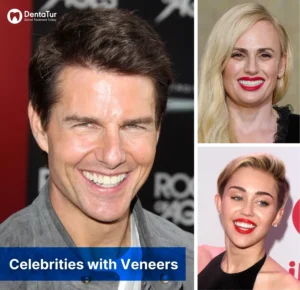Celebrities with veneers