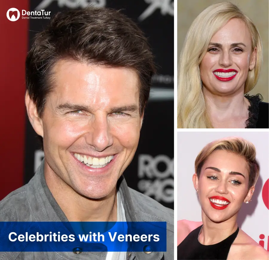 Celebrities with veneers