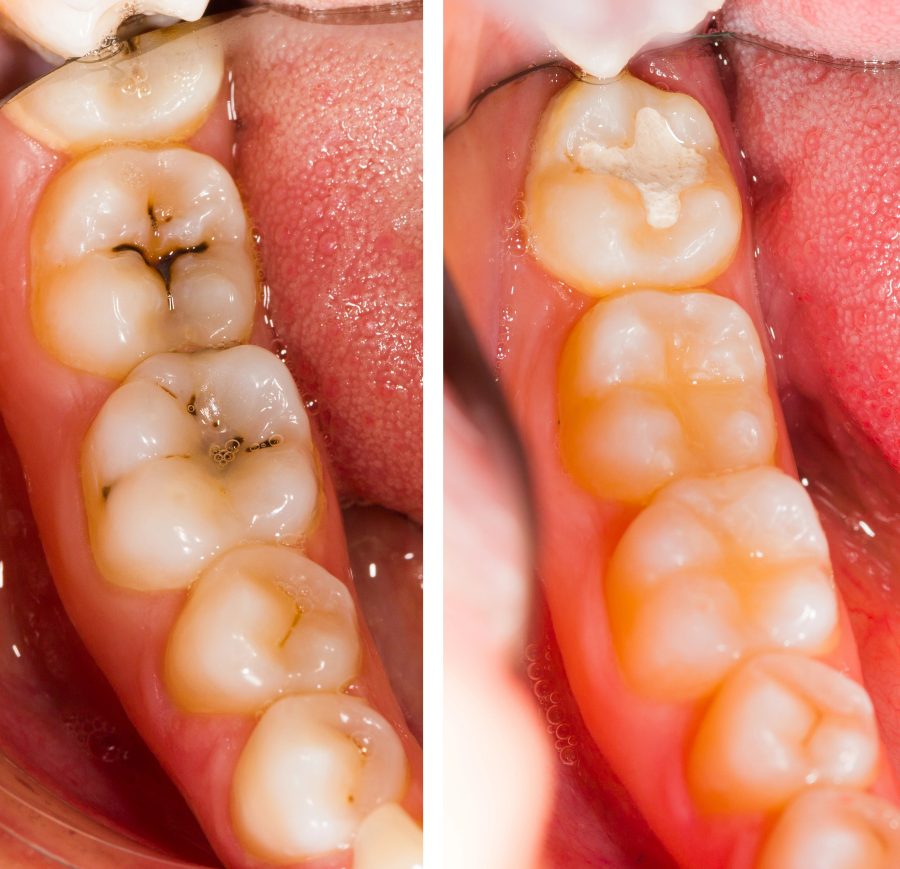 Composite dental fillings