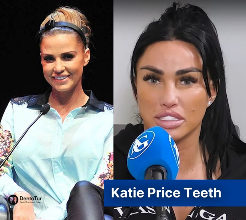 Katie Price Teeth