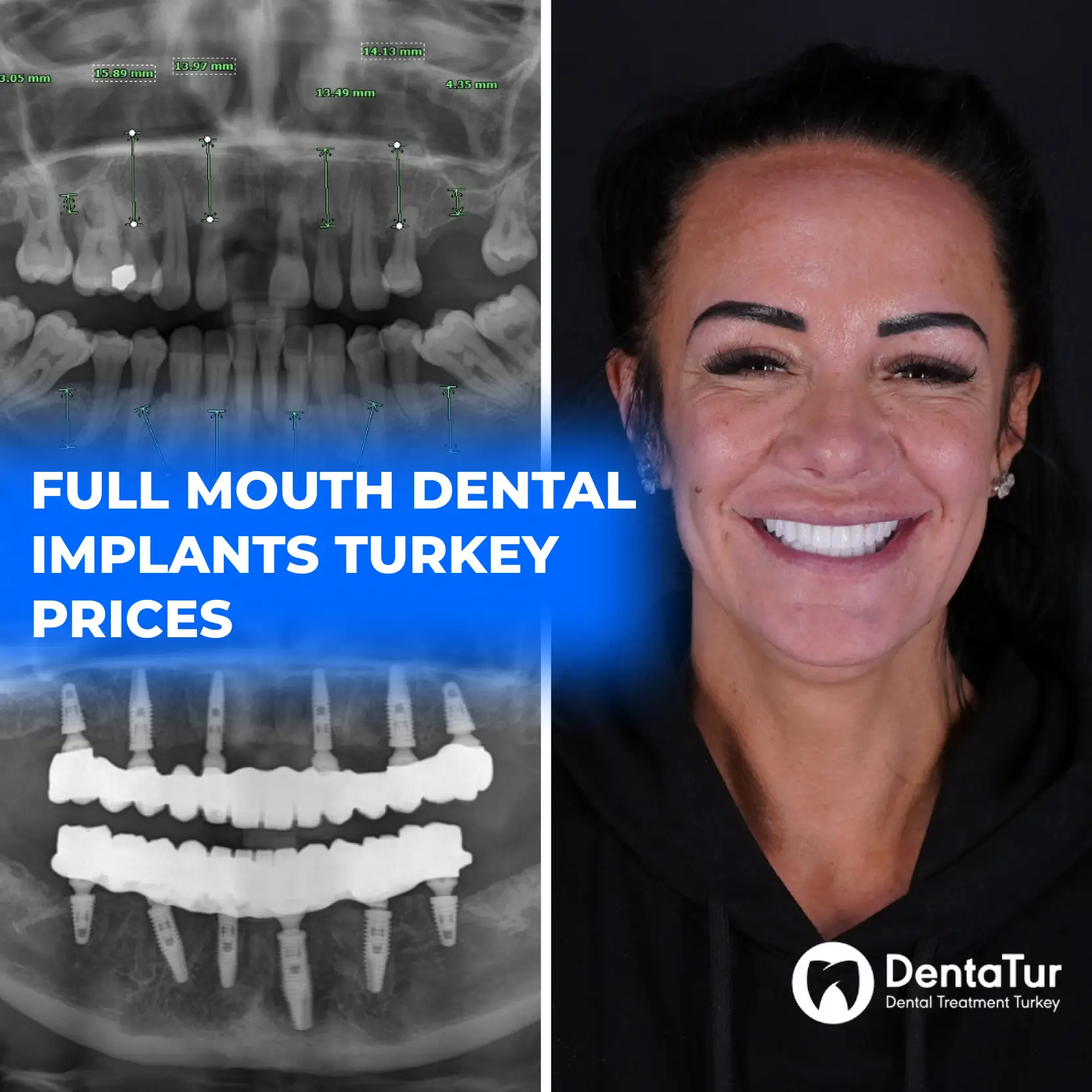Full Mouth Dental Implants Turkey Price