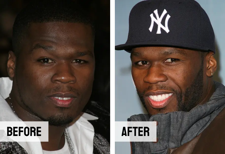 50 Cent Teeth Before After