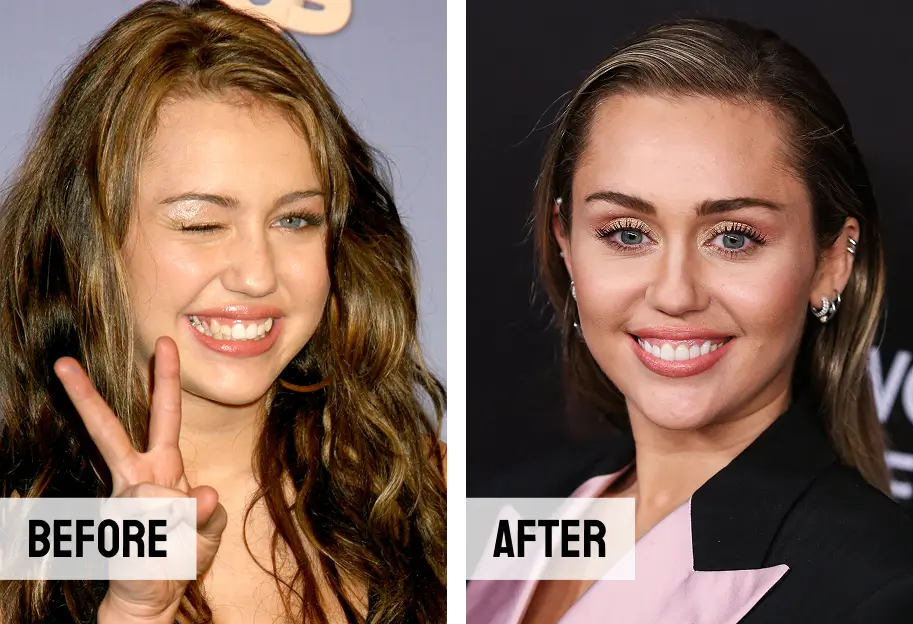 Before after Miley Cyrus Veneers Teeth