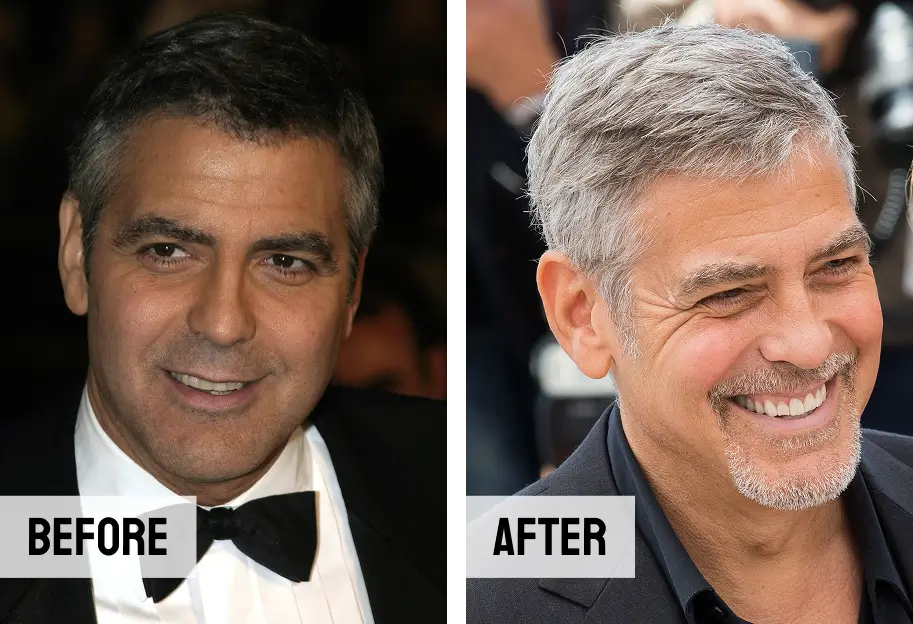 George Clooney Teeth Before After