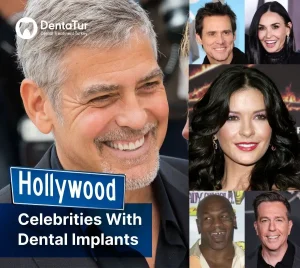 Hollywood celebrities with dental implants