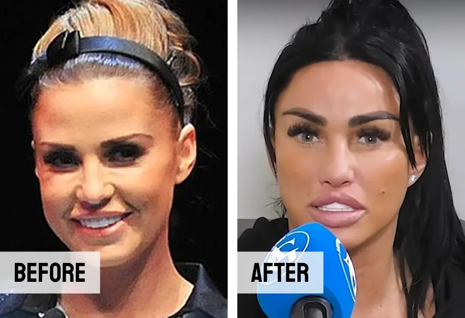 Katie Price Teeth Veneers Before After