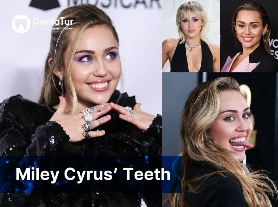 Miley Cyrus's Teeth Veneers