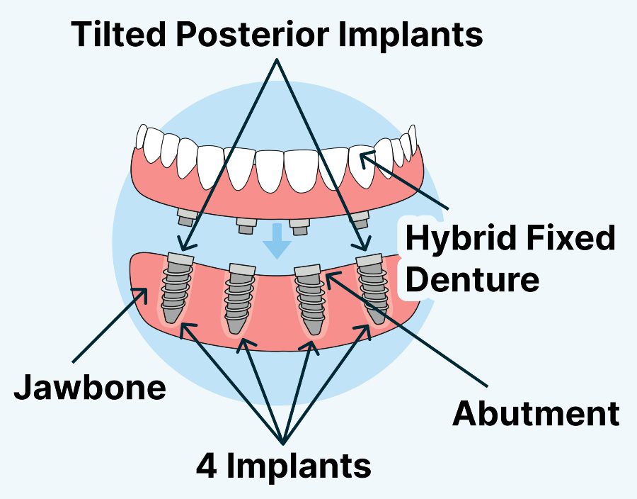 All on 4 Dental Implants Information Components Pieces