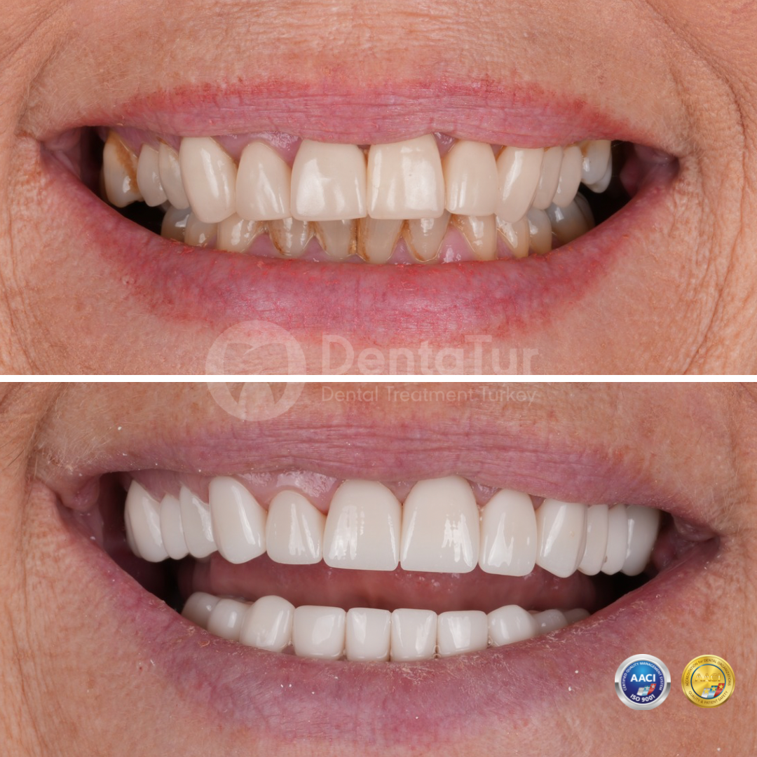 Dental crowns before after