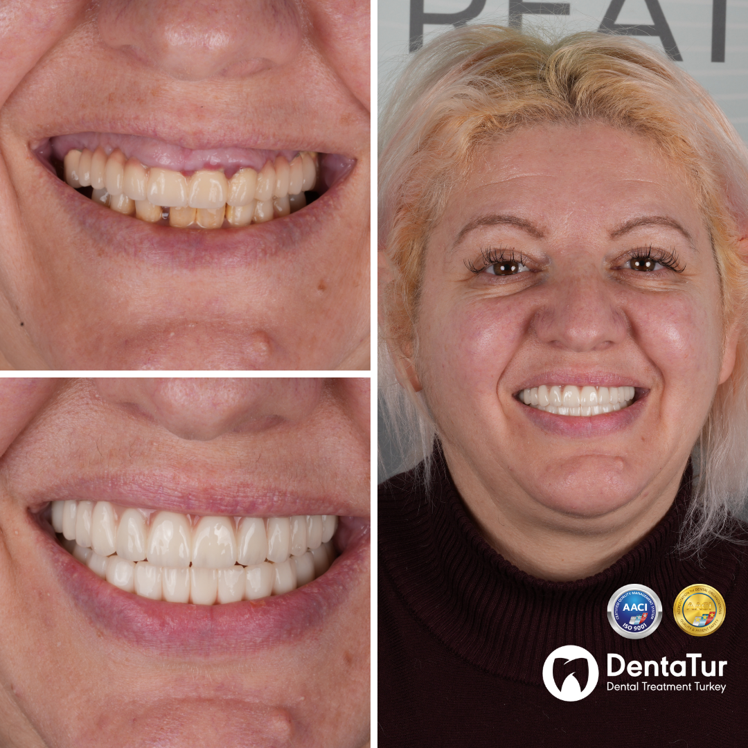 full mouth dental implants with zirconium crowns before after