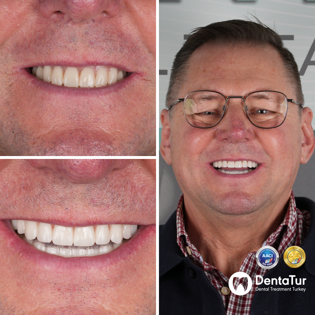 full mouth dental implants with zirconium crowns before after