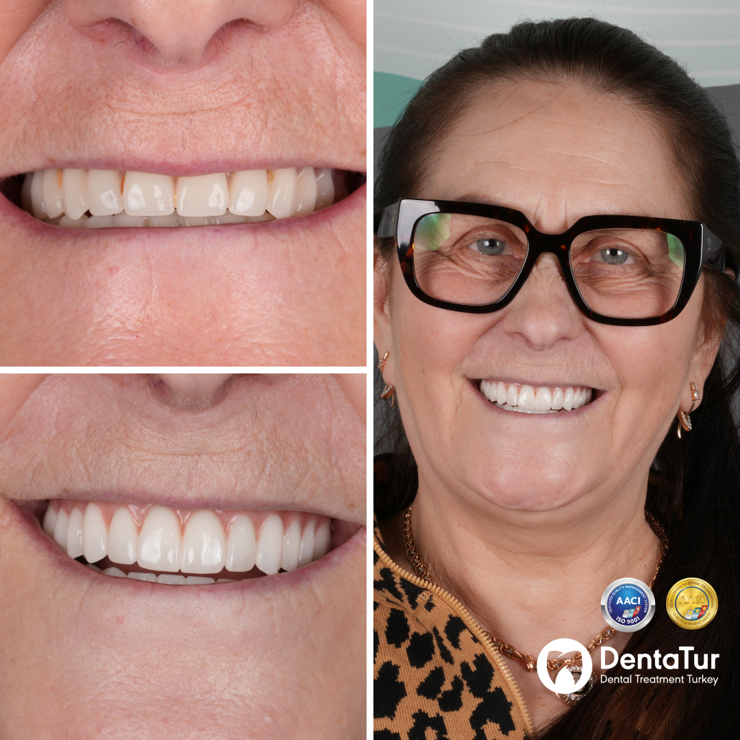 dental implants with zirconium crowns before after