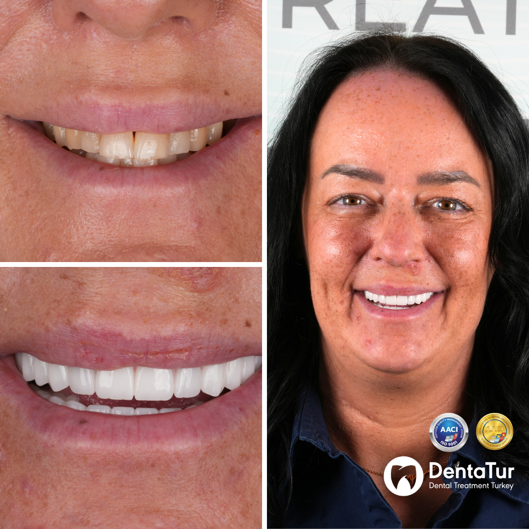 dental implants and zirconium crowns before after
