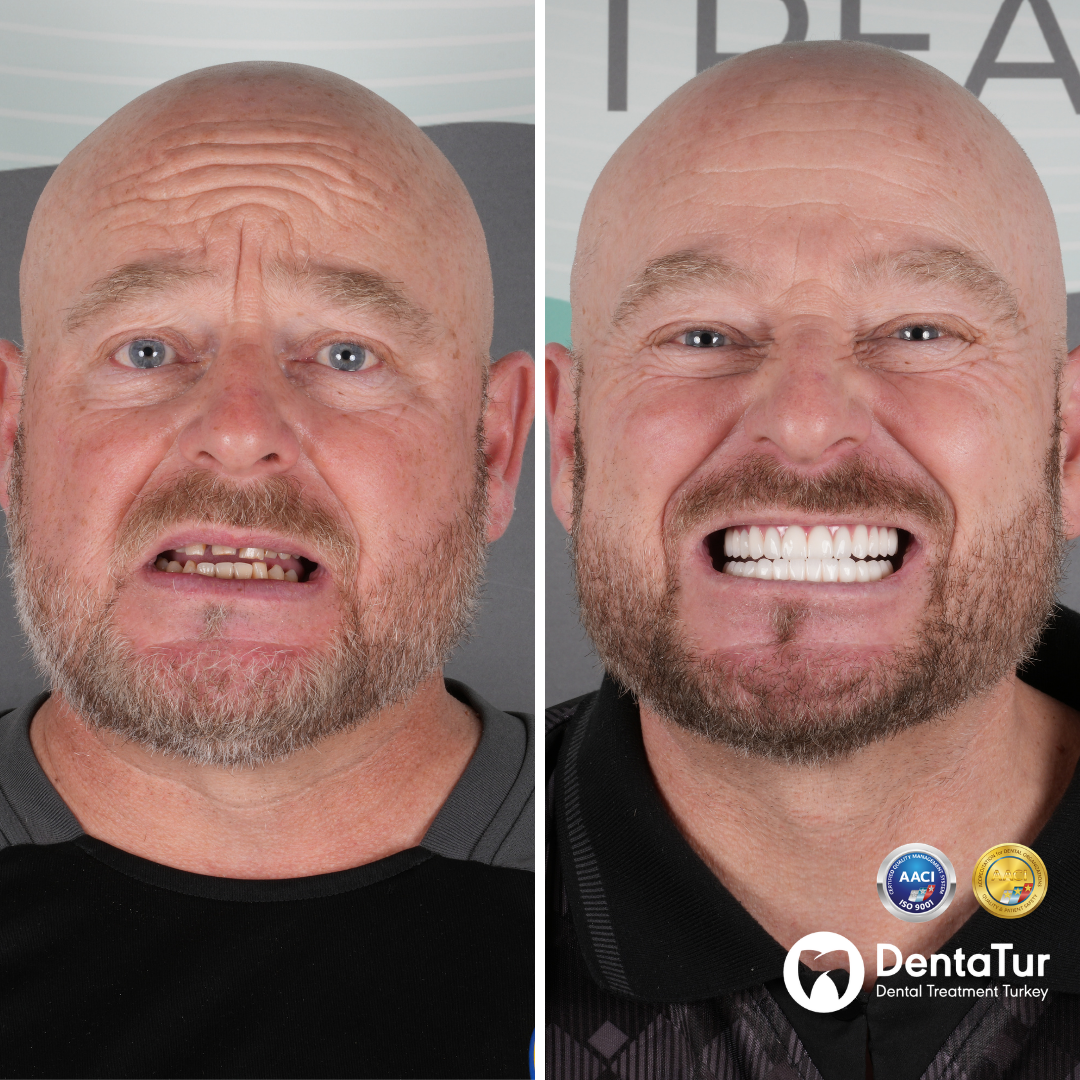 dental implants with zirconium crowns before after