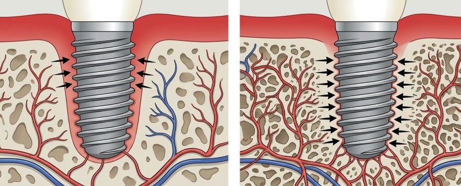 Osseointegration and implant healing process