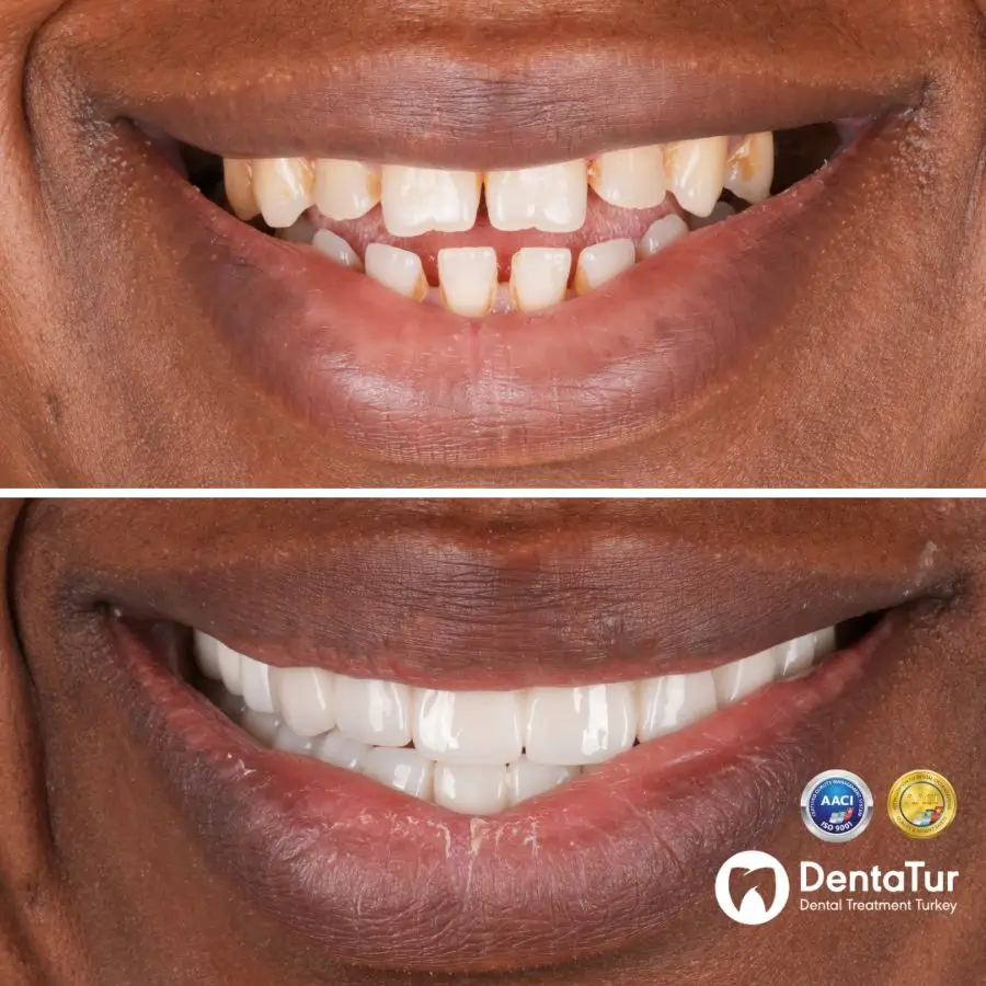 dental implants with zirconium crowns before and after
