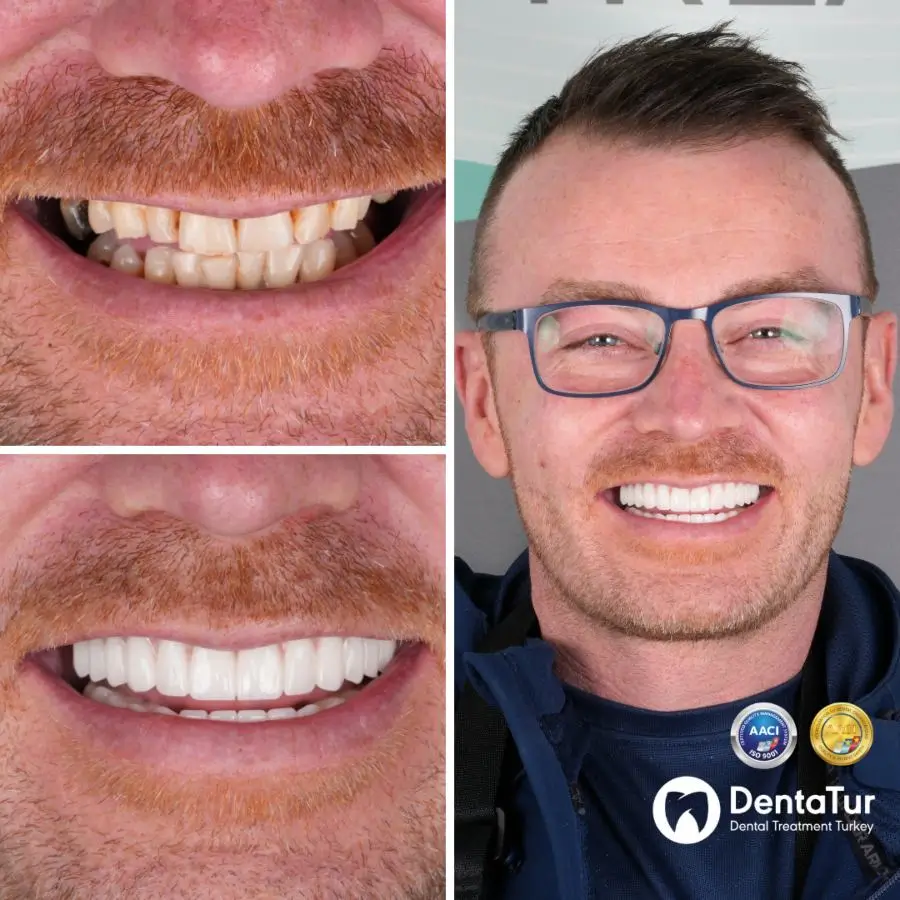 dental implants with zirconium crowns