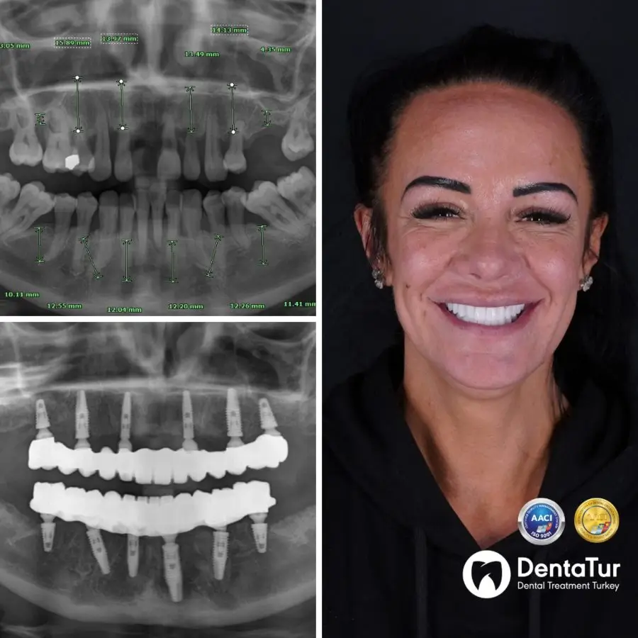 full mouth dental implants