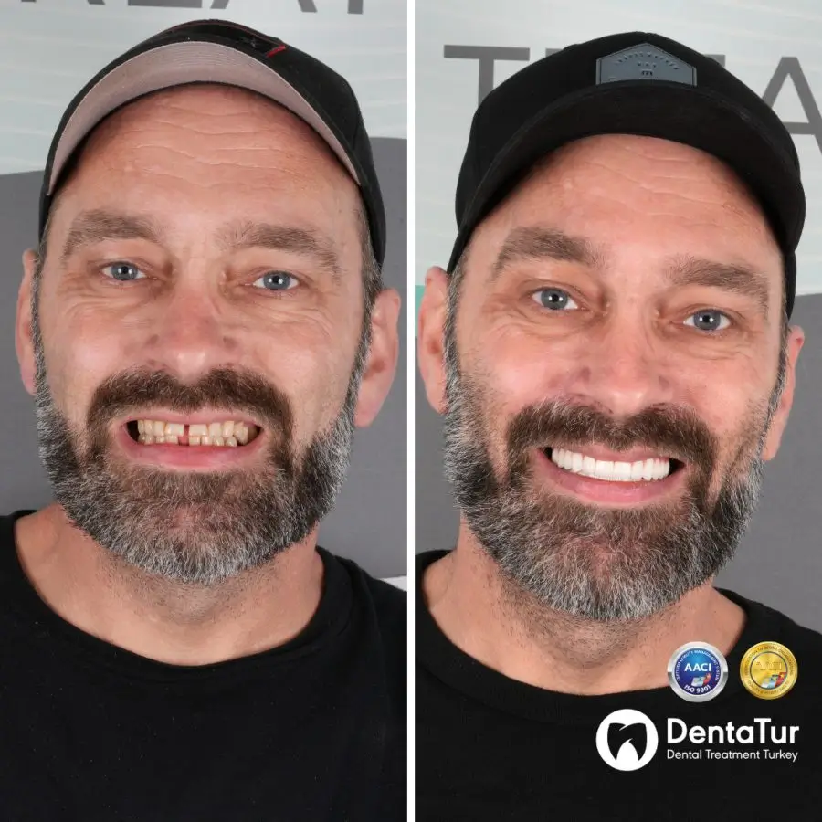 full mouth dental implants