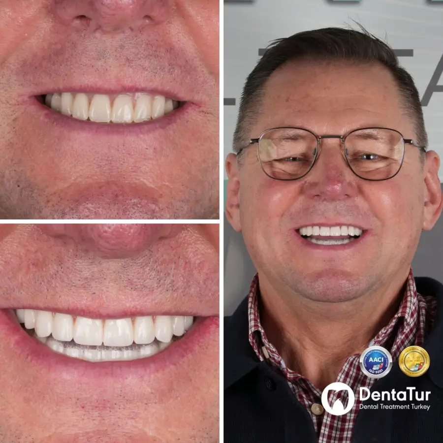 full mouth dental implants before after