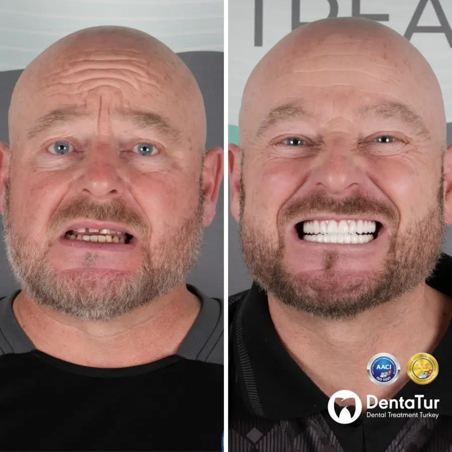 full mouth dental implants in Antalya